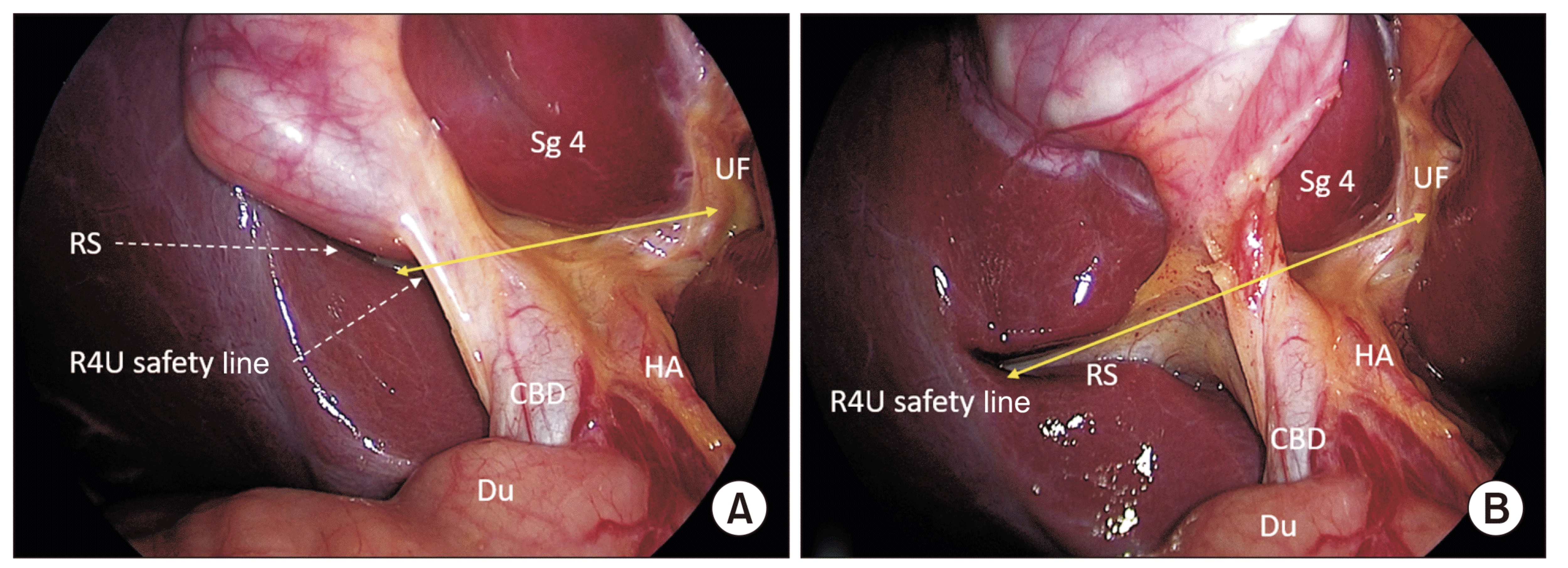 Gallbladder Surgery
